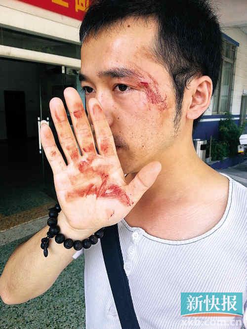 本報一記者眼角被打傷,流血不止。